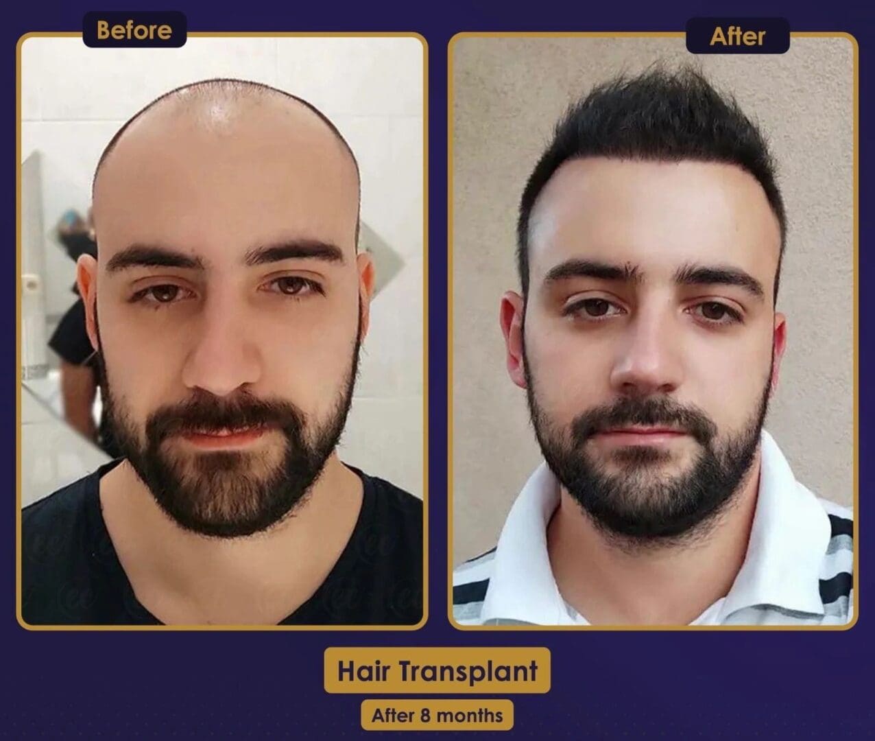 A before and after picture of a man 's hair transplant.