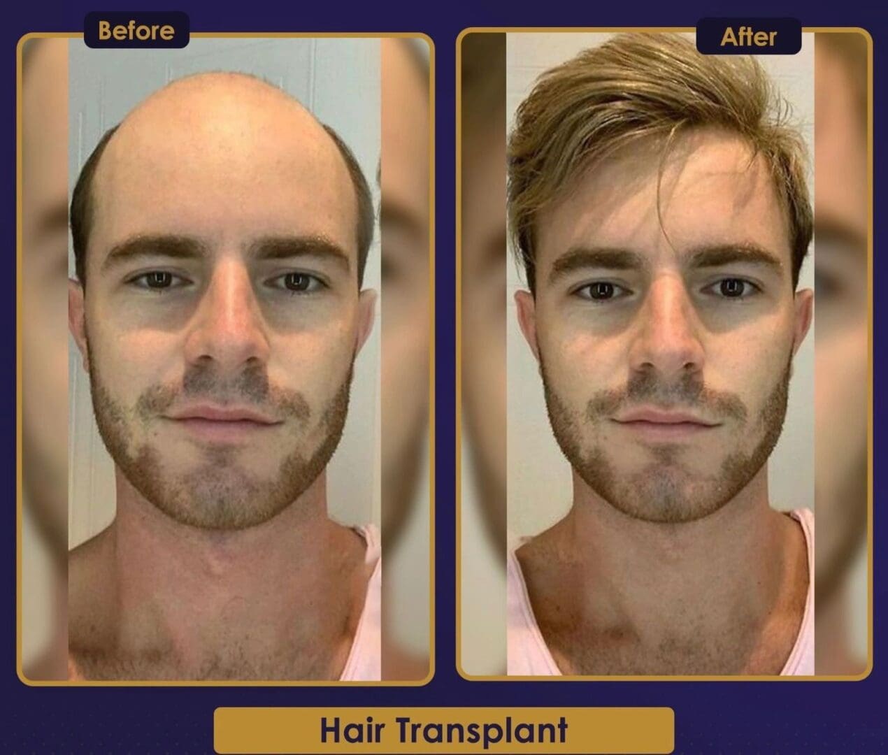 A before and after picture of a man 's hair transplant.