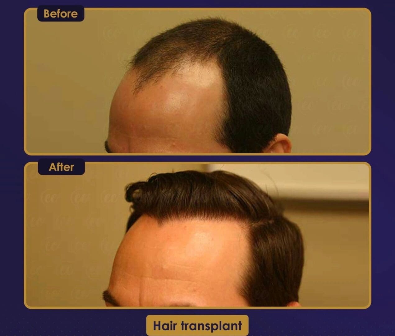 A man with a hair transplant is before and after.