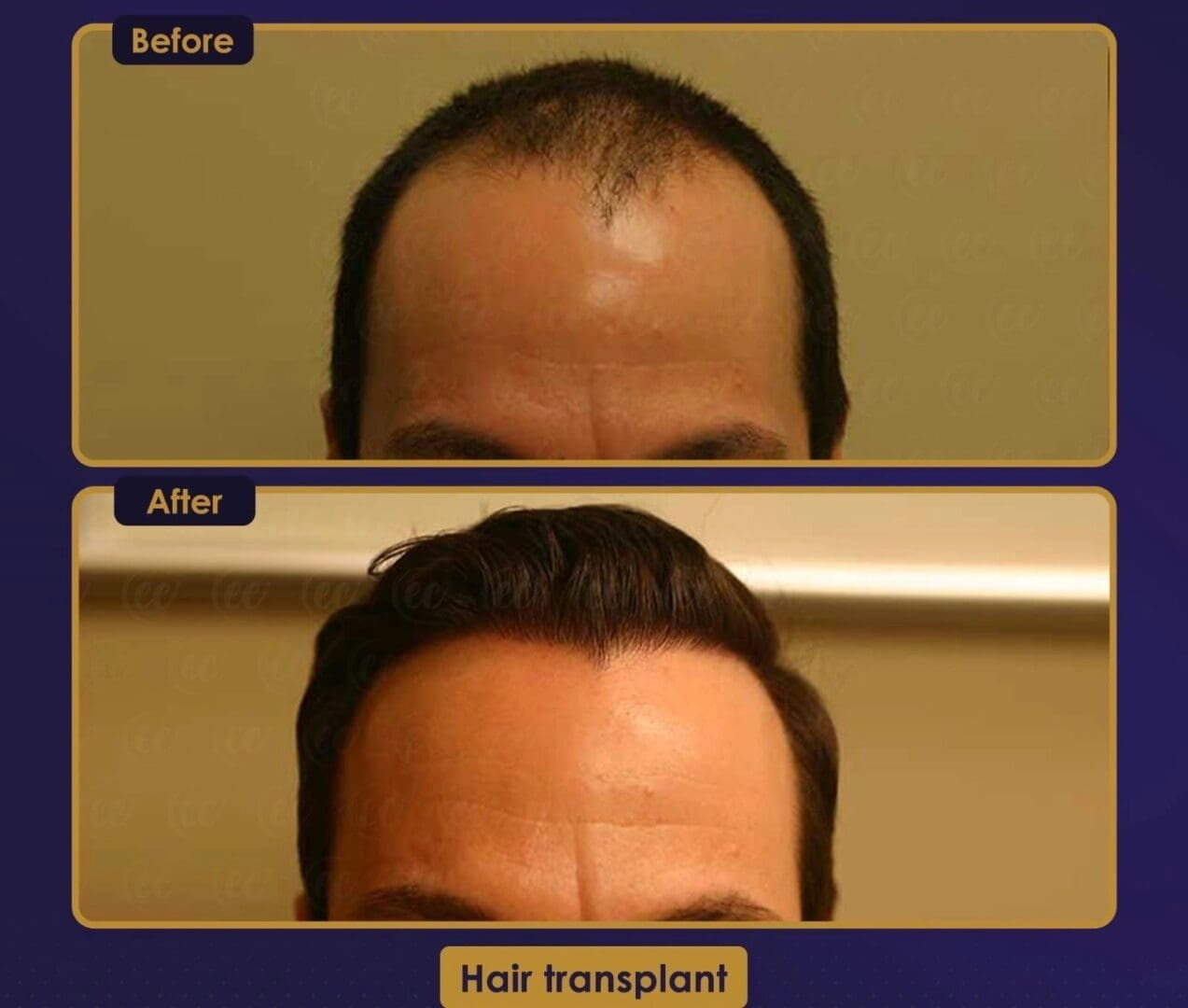 A man with hair loss and before and after photos.