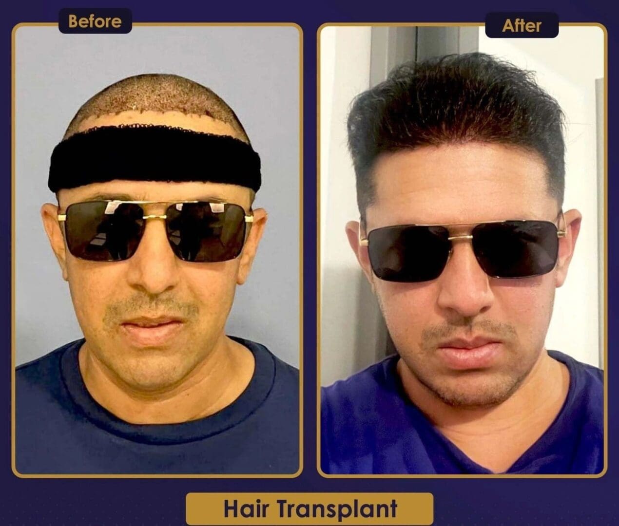 A before and after picture of hair transplant surgery.