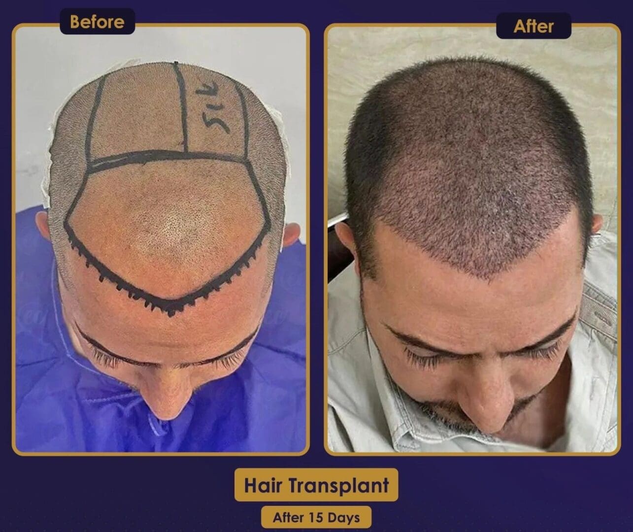 A man with a shaved head and no hair is before and after his haircut.