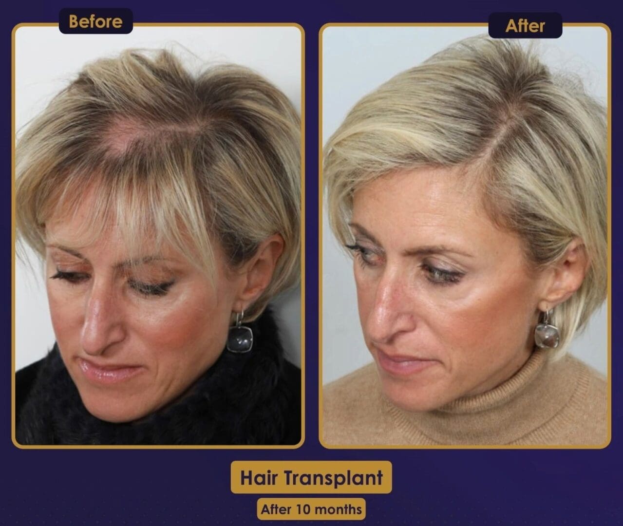 A before and after picture of a woman 's hair transplant.