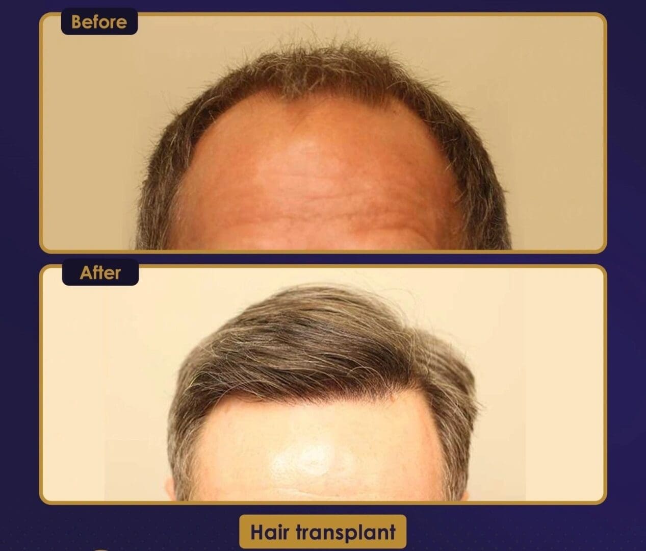 A before and after picture of a man 's hair transplant.