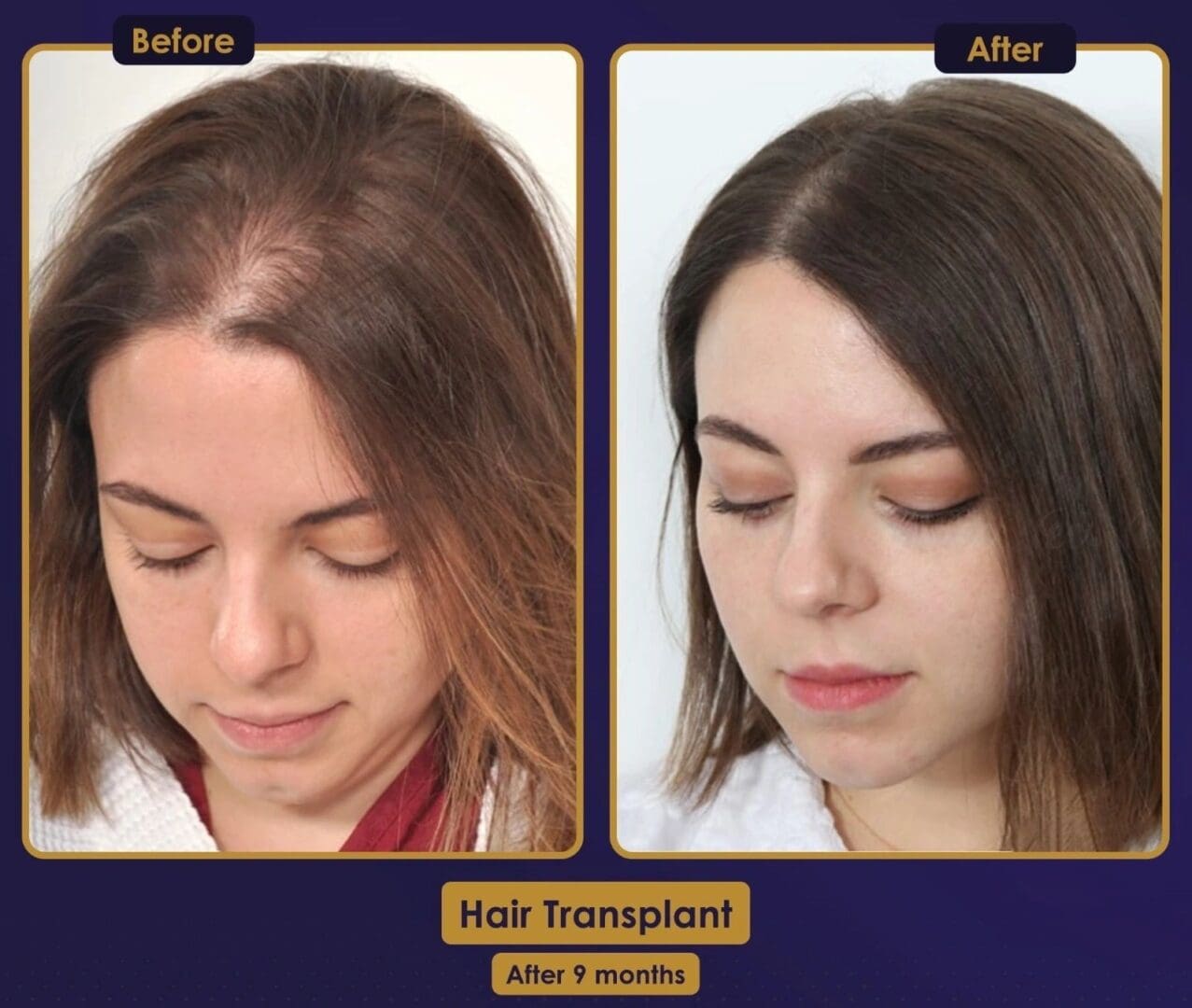 A before and after picture of a woman 's hair transplant.