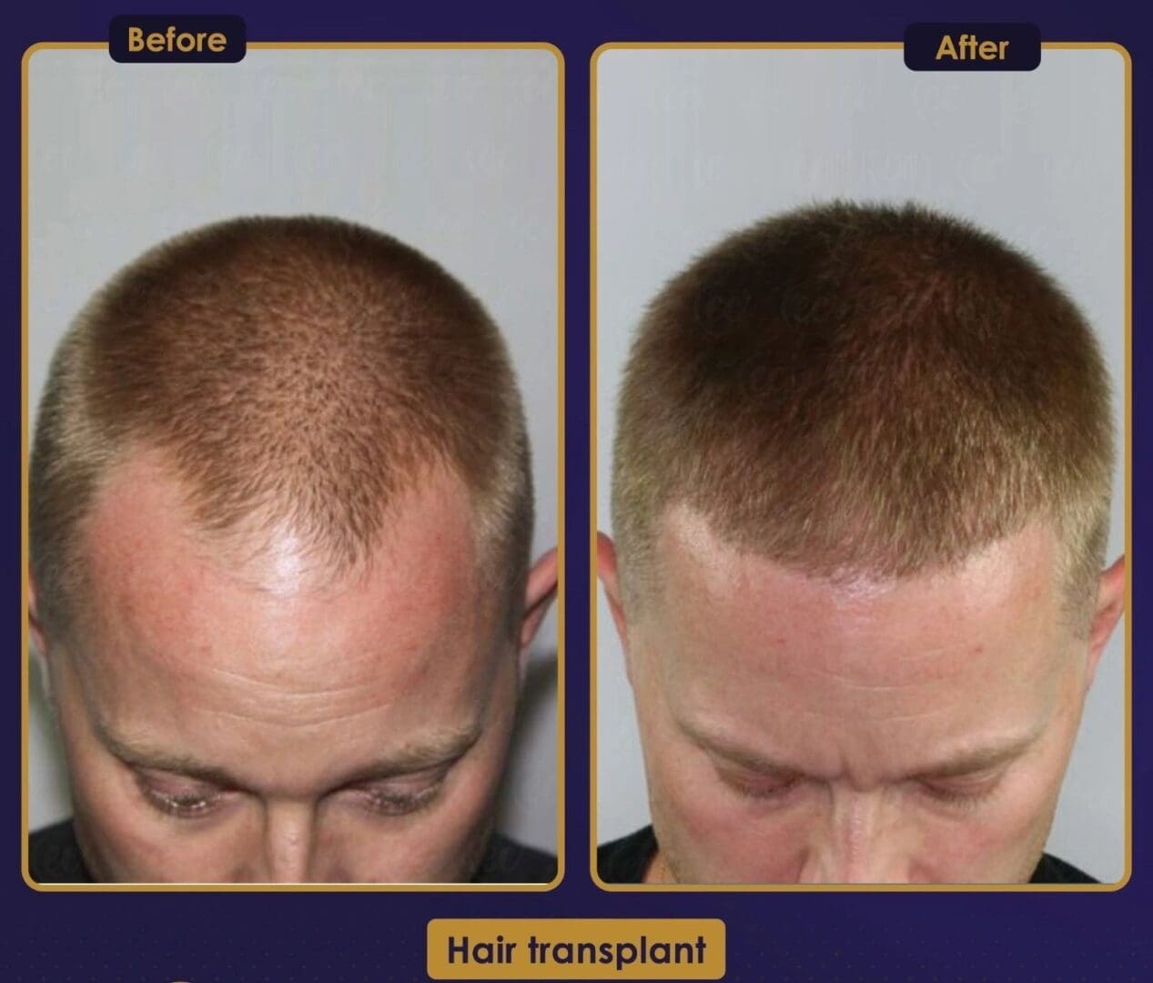 A man with a bald head and before and after photos of his hair transplant.