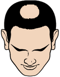 A cartoon illustration of male pattern baldness.