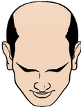 Cartoon of a man with receding hairline.