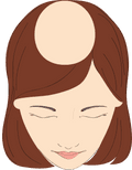 Illustration of a woman with alopecia areata.