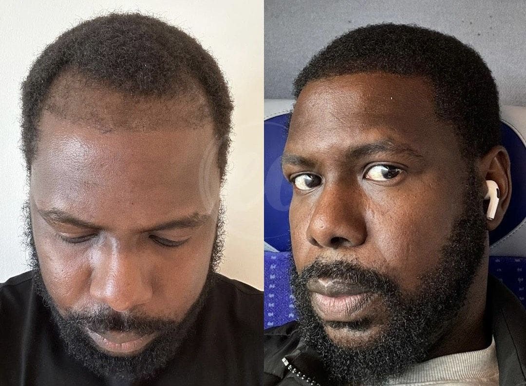 Before and after hair loss treatment.