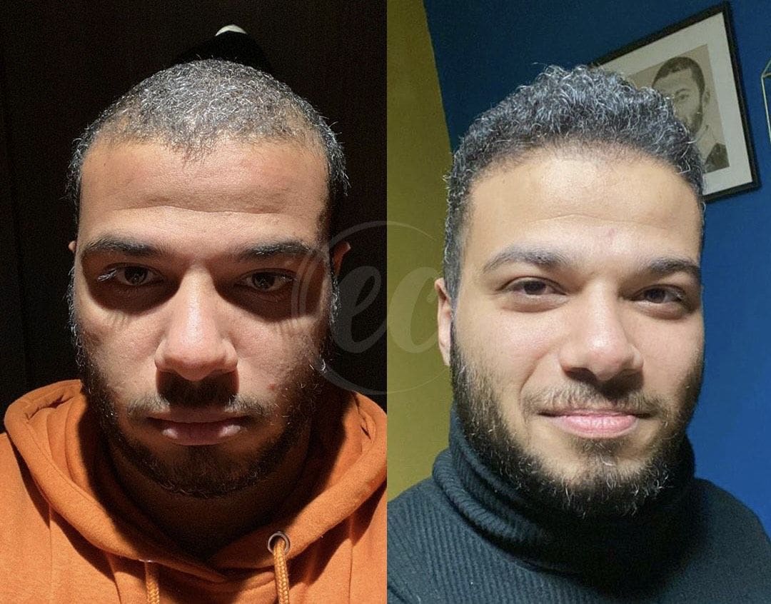 Before and after photo of a man with facial hair.